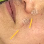 シワ改善鍼の写真