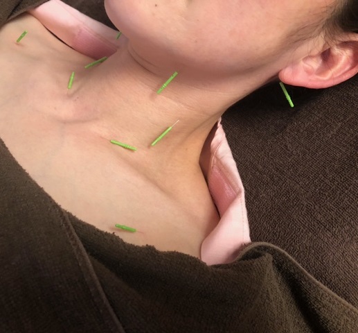 シワ改善鍼の写真