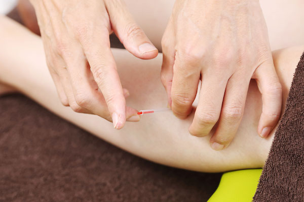 保険治療の鍼灸施術療養の写真