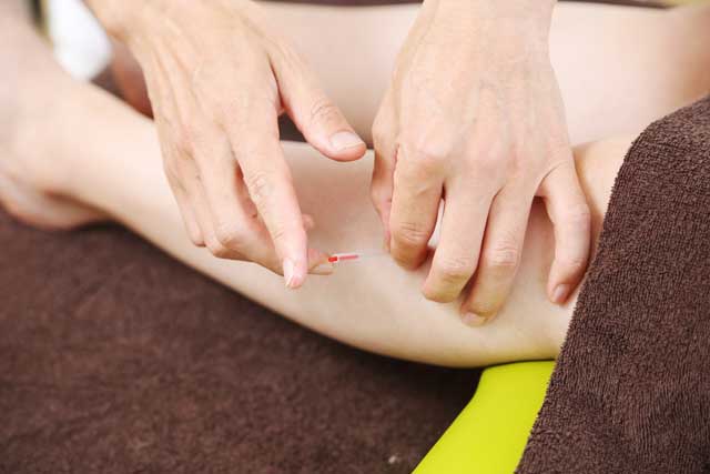 鍼灸治療中の写真